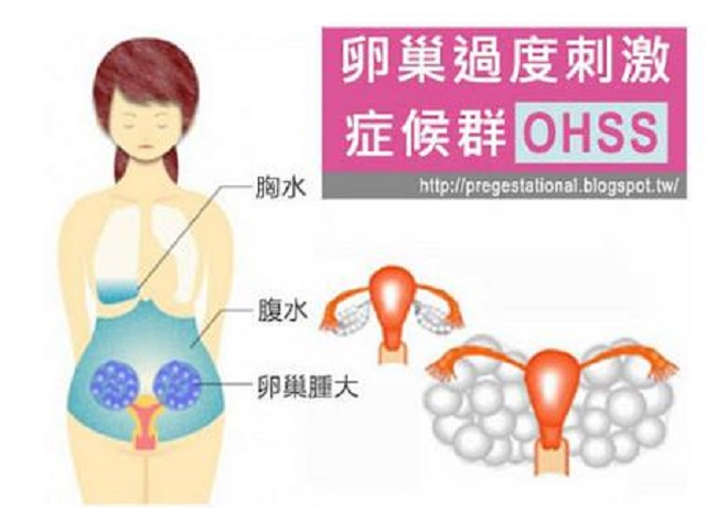 带您了解卵巢过度刺激综合征