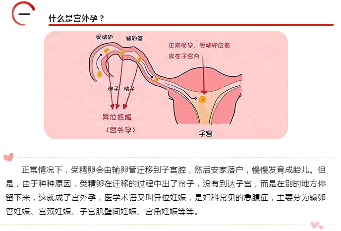 甲氨蝶呤在异位妊娠中的应用有什么呢？