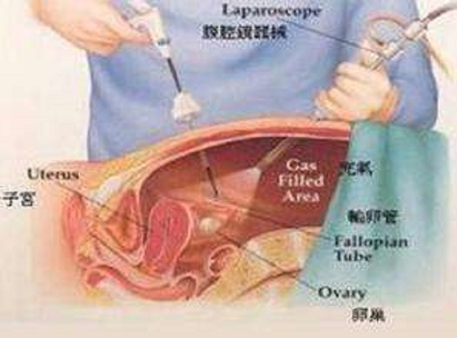 有关输卵管造影术，您了解多少？