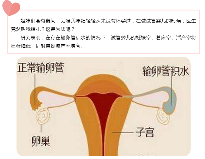 为什么我还没有怀过孕医生就让我结扎？