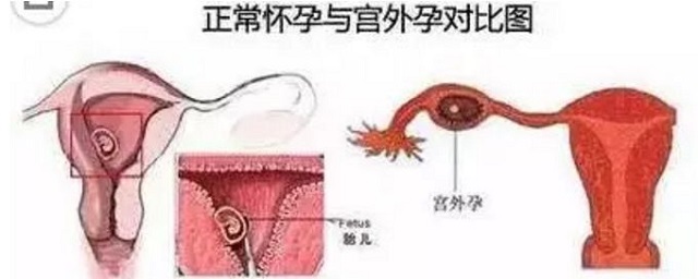 试管婴儿助孕，就可以避免得宫外孕吗？