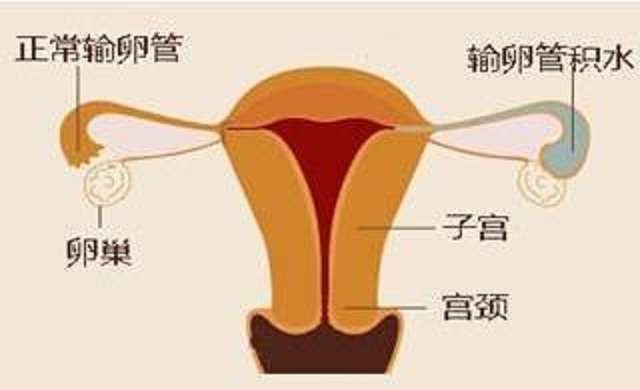 输卵管积水，您真的了解吗？