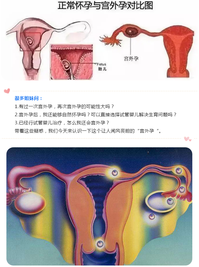 关于宫外孕的那些事