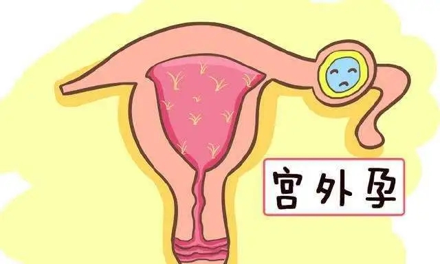 妇科科普｜什么？输卵管结扎也会宫外孕？