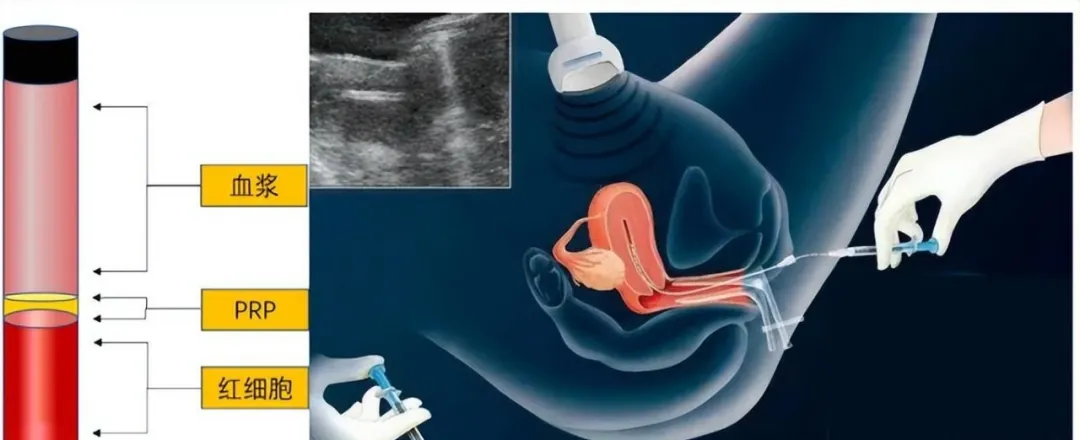 子宫内膜薄、容受性差？PRP宫腔灌注技术为您“肥沃土壤”！